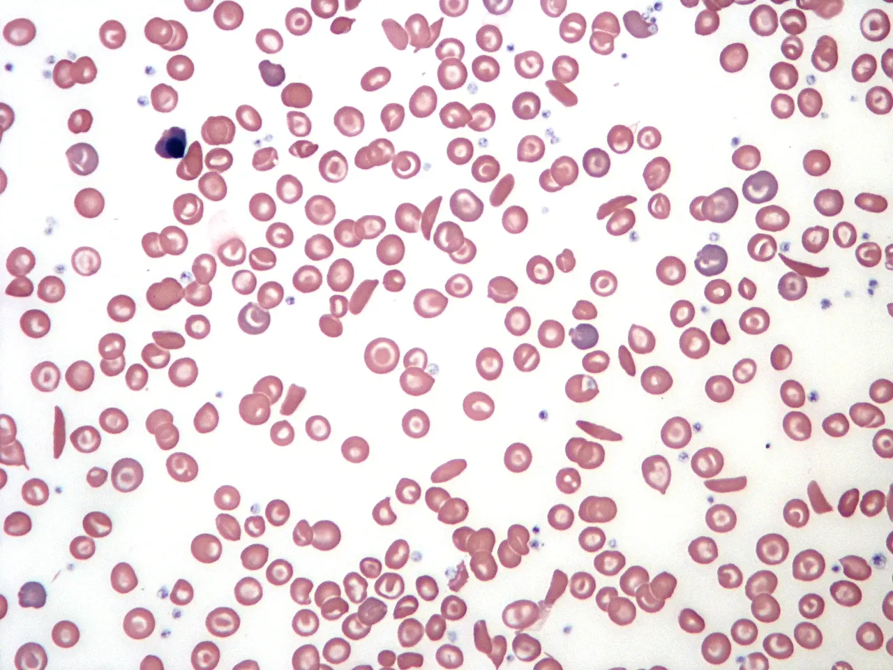 Blood smear illustrating sickle cell anaemia. Stained with Giemsa. Note the distinctive "sickle" shape, and "target cells" with concentric rings of red stain.